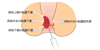 4段階注射法